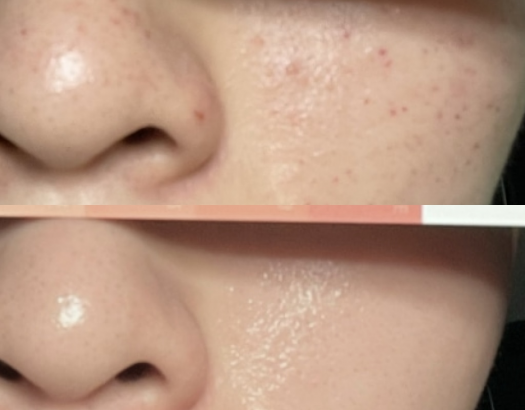 EGF is a perfect solution for skin troubles